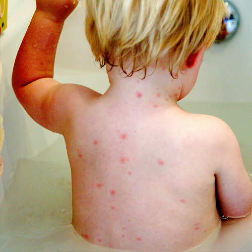 Chicken Pox Symptoms In Vaccinated Children - HealthTap
